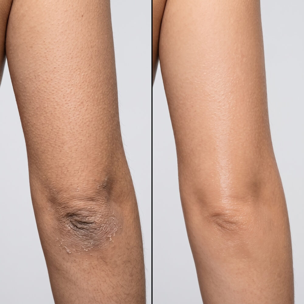AI illustration 1: matching skin surfaces with and without loose flakes; not actual results
